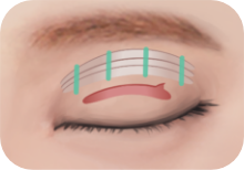 순서 3: 상안검거근의 근육을 당겨 봉합