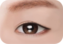 쌍꺼풀이 처진 경우