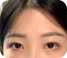 이마가 좁고 우울해 보이는 인상인 경우