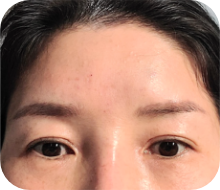 노화로 쌍꺼풀라인이 짝짝이인 경우