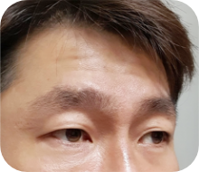 이마 주름이 깊고 많은 경우