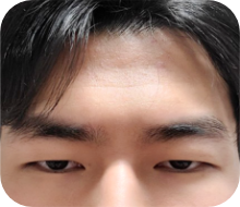 눈뜨는 힘이 부족한 경우