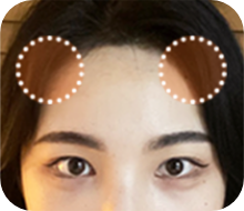 순서 1 : 절개부위 결정
