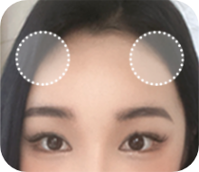 순서 5 : 소독
