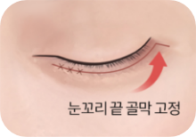 순서 3: 늘어진 근육을 골막에 고정하여 주름을 제거 후 봉합