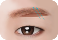 순서 2: 처진 눈꺼풀을 잡아 위로 당김