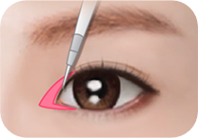 Step 2: 눈 앞꼬리의 안쪽 결막 절개