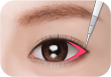 Step 2: 안쪽 결막을 절개
