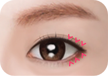 Step 3: 흉터가 보이지 않도록 봉합